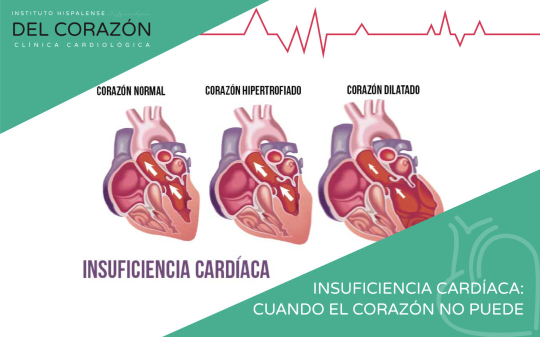 Insuficiencia cardíaca: cuando el corazón ya no puede más