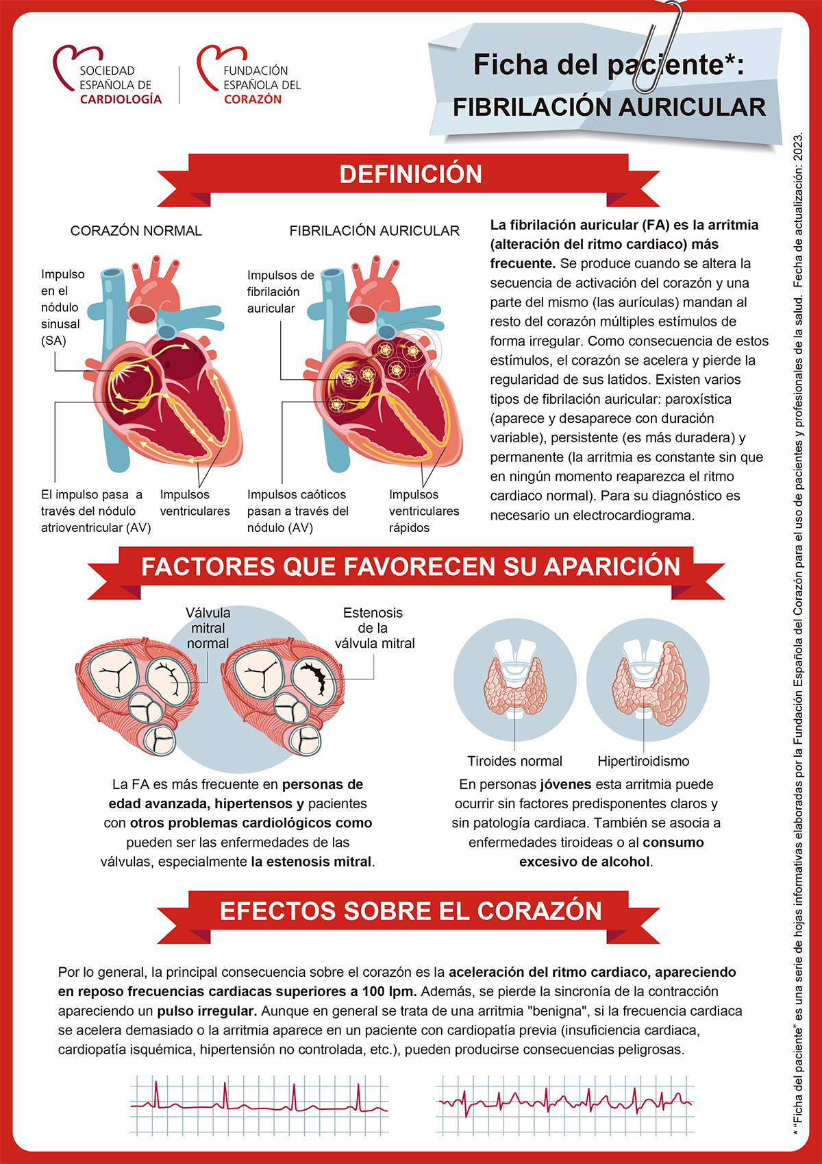 Ficha Fibrilacion Auricular