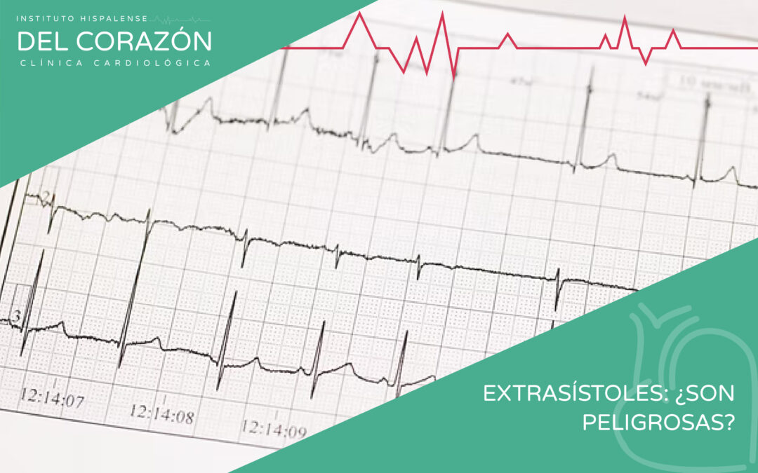 Extrasístoles: ¿Son peligrosas? Cuándo acudir a un cardiólogo en Sevilla